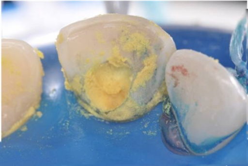 Descripción: Clinical examination revealed 7-mm probing depths, circumferentially around a mandibular implant, bleeding on probing, and the presence of exudate and gingival inflammatory edema