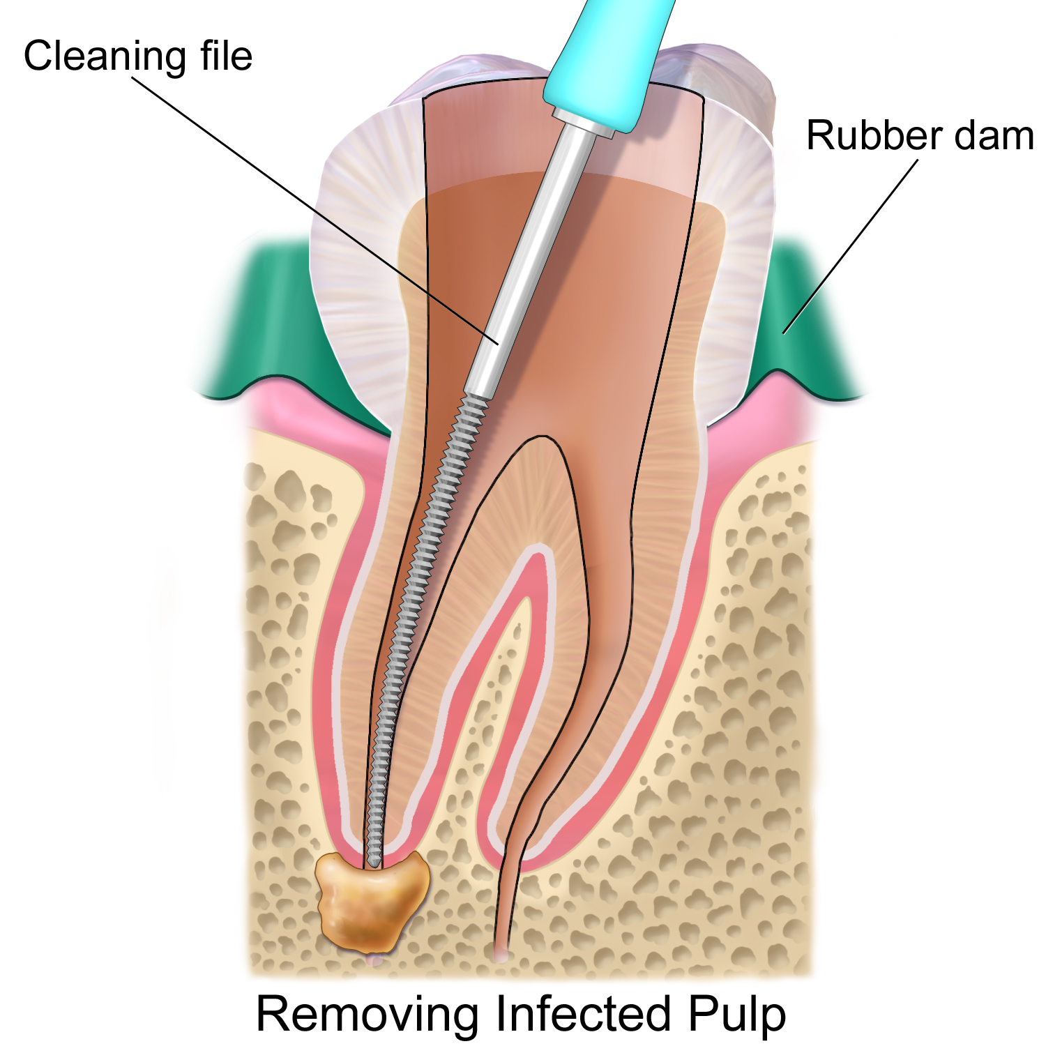 Descripción: Clinical examination revealed 7-mm probing depths, circumferentially around a mandibular implant, bleeding on probing, and the presence of exudate and gingival inflammatory edema