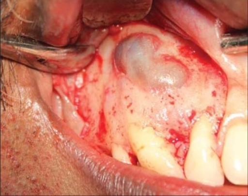 quiste odontogénico glandular