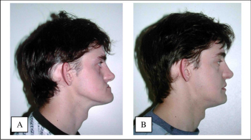 Descripción: Clinical examination revealed 7-mm probing depths, circumferentially around a mandibular implant, bleeding on probing, and the presence of exudate and gingival inflammatory edema