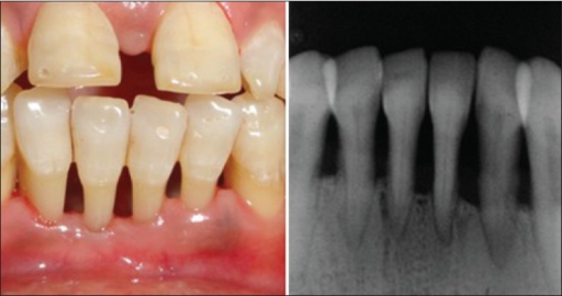 Descripción: Clinical examination revealed 7-mm probing depths, circumferentially around a mandibular implant, bleeding on probing, and the presence of exudate and gingival inflammatory edema