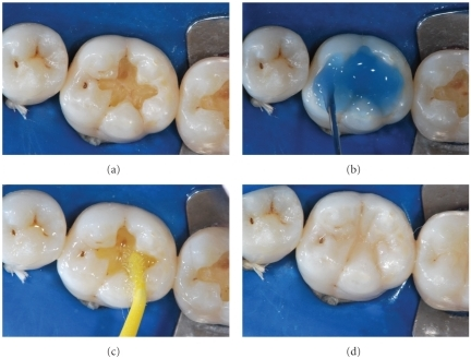 Descripción: Clinical examination revealed 7-mm probing depths, circumferentially around a mandibular implant, bleeding on probing, and the presence of exudate and gingival inflammatory edema