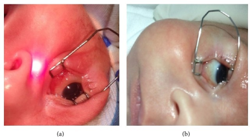 Descripción: Clinical examination revealed 7-mm probing depths, circumferentially around a mandibular implant, bleeding on probing, and the presence of exudate and gingival inflammatory edema