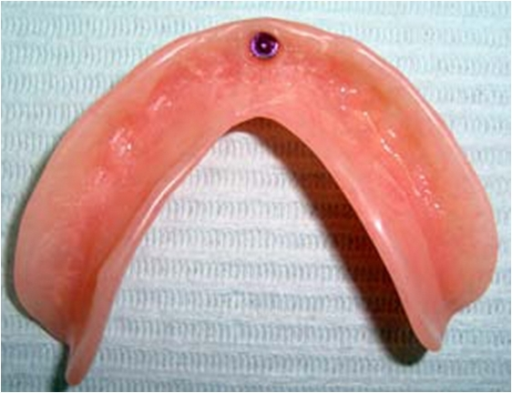 Descripción: Clinical examination revealed 7-mm probing depths, circumferentially around a mandibular implant, bleeding on probing, and the presence of exudate and gingival inflammatory edema