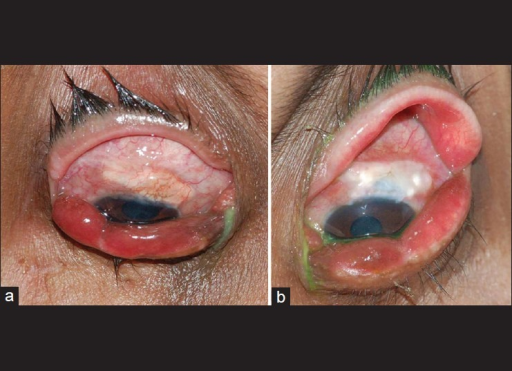 Descripción: Clinical examination revealed 7-mm probing depths, circumferentially around a mandibular implant, bleeding on probing, and the presence of exudate and gingival inflammatory edema