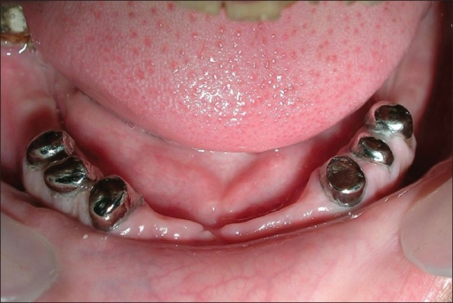 Descripción: Clinical examination revealed 7-mm probing depths, circumferentially around a mandibular implant, bleeding on probing, and the presence of exudate and gingival inflammatory edema