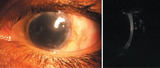 Descripción: Clinical examination revealed 7-mm probing depths, circumferentially around a mandibular implant, bleeding on probing, and the presence of exudate and gingival inflammatory edema