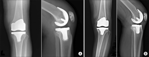 Descripción: Clinical examination revealed 7-mm probing depths, circumferentially around a mandibular implant, bleeding on probing, and the presence of exudate and gingival inflammatory edema