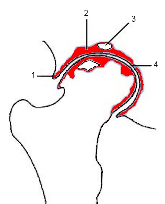 Descripción: Clinical examination revealed 7-mm probing depths, circumferentially around a mandibular implant, bleeding on probing, and the presence of exudate and gingival inflammatory edema