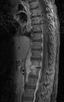 Descripción: Clinical examination revealed 7-mm probing depths, circumferentially around a mandibular implant, bleeding on probing, and the presence of exudate and gingival inflammatory edema