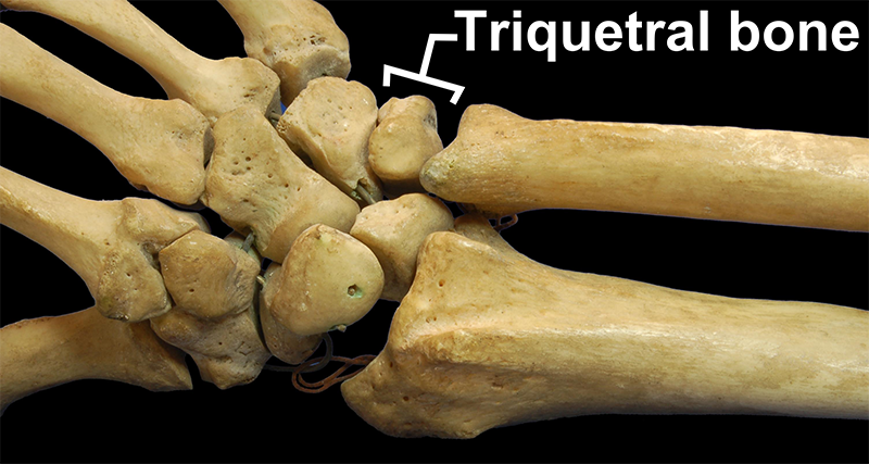 Descripción: Clinical examination revealed 7-mm probing depths, circumferentially around a mandibular implant, bleeding on probing, and the presence of exudate and gingival inflammatory edema