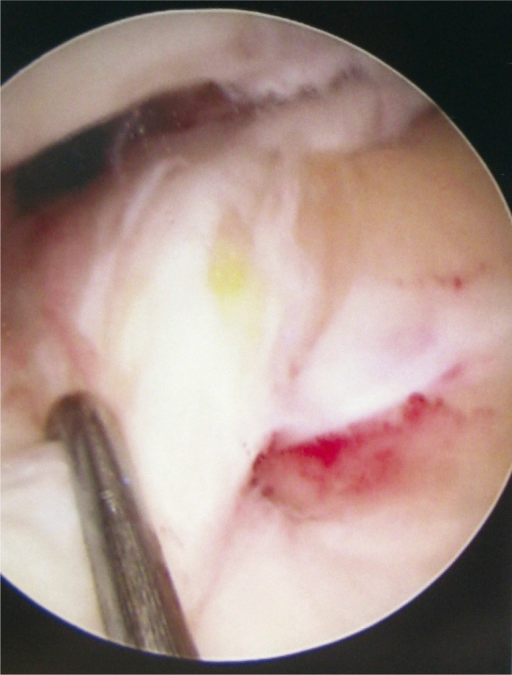 Descripción: Clinical examination revealed 7-mm probing depths, circumferentially around a mandibular implant, bleeding on probing, and the presence of exudate and gingival inflammatory edema