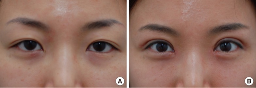 Descripción: Clinical examination revealed 7-mm probing depths, circumferentially around a mandibular implant, bleeding on probing, and the presence of exudate and gingival inflammatory edema