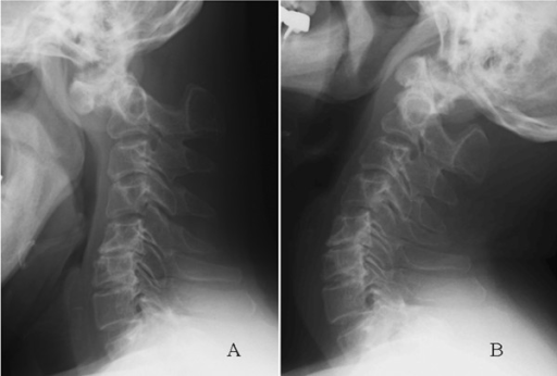 Descripción: Clinical examination revealed 7-mm probing depths, circumferentially around a mandibular implant, bleeding on probing, and the presence of exudate and gingival inflammatory edema