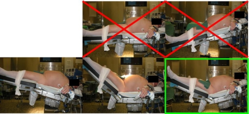 Descripción: Clinical examination revealed 7-mm probing depths, circumferentially around a mandibular implant, bleeding on probing, and the presence of exudate and gingival inflammatory edema