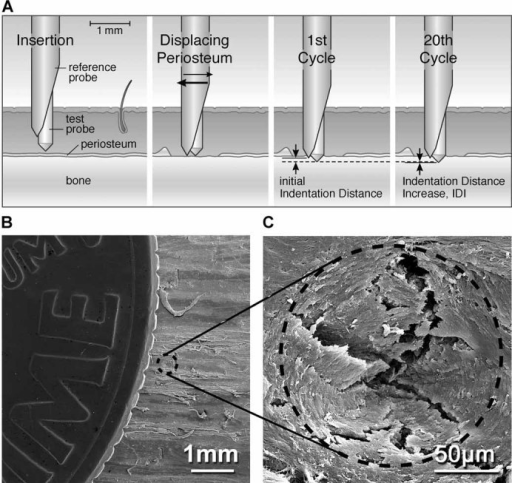 Descripción: Clinical examination revealed 7-mm probing depths, circumferentially around a mandibular implant, bleeding on probing, and the presence of exudate and gingival inflammatory edema