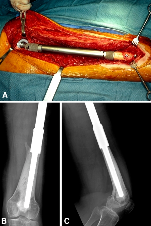 Descripción: Clinical examination revealed 7-mm probing depths, circumferentially around a mandibular implant, bleeding on probing, and the presence of exudate and gingival inflammatory edema