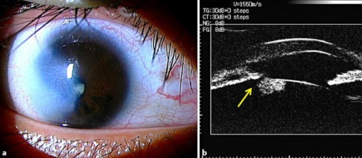 Descripción: Clinical examination revealed 7-mm probing depths, circumferentially around a mandibular implant, bleeding on probing, and the presence of exudate and gingival inflammatory edema