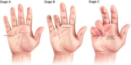 Descripción: Clinical examination revealed 7-mm probing depths, circumferentially around a mandibular implant, bleeding on probing, and the presence of exudate and gingival inflammatory edema