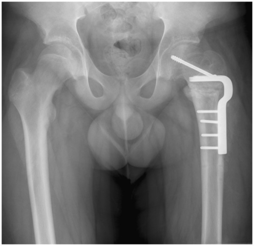 Descripción: Clinical examination revealed 7-mm probing depths, circumferentially around a mandibular implant, bleeding on probing, and the presence of exudate and gingival inflammatory edema