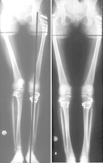 Descripción: Clinical examination revealed 7-mm probing depths, circumferentially around a mandibular implant, bleeding on probing, and the presence of exudate and gingival inflammatory edema