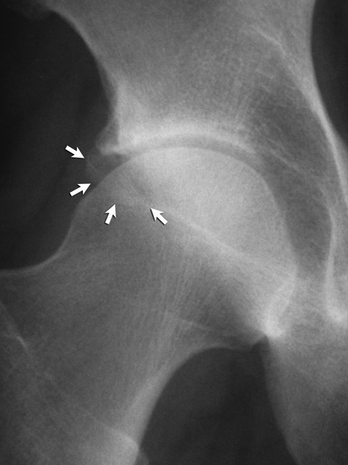 Descripción: Clinical examination revealed 7-mm probing depths, circumferentially around a mandibular implant, bleeding on probing, and the presence of exudate and gingival inflammatory edema