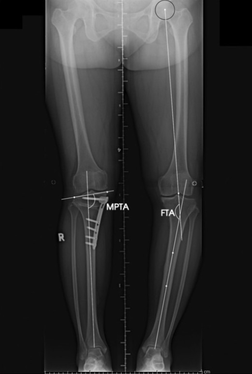 Descripción: Clinical examination revealed 7-mm probing depths, circumferentially around a mandibular implant, bleeding on probing, and the presence of exudate and gingival inflammatory edema