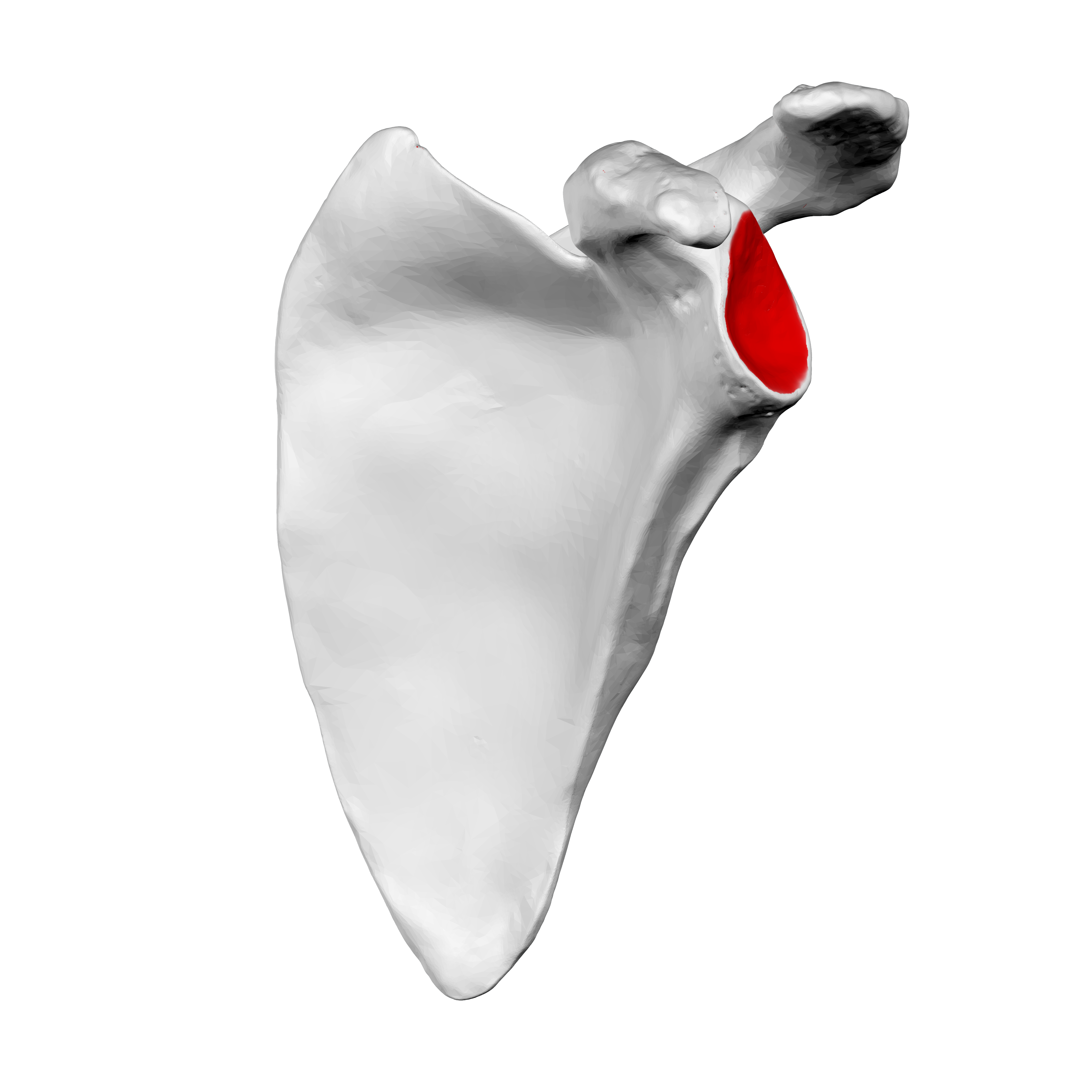 Descripción: Clinical examination revealed 7-mm probing depths, circumferentially around a mandibular implant, bleeding on probing, and the presence of exudate and gingival inflammatory edema