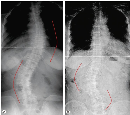 Descripción: Clinical examination revealed 7-mm probing depths, circumferentially around a mandibular implant, bleeding on probing, and the presence of exudate and gingival inflammatory edema