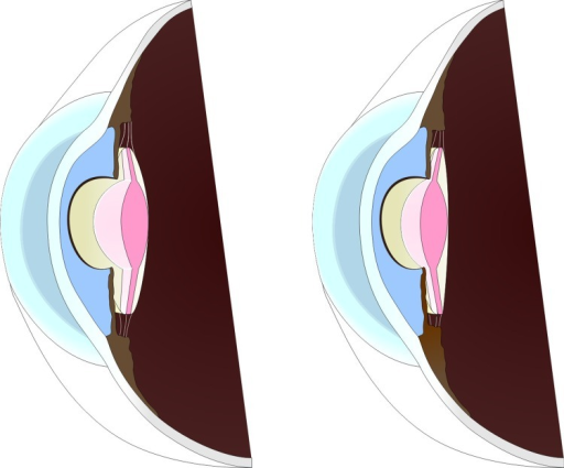 Descripción: Clinical examination revealed 7-mm probing depths, circumferentially around a mandibular implant, bleeding on probing, and the presence of exudate and gingival inflammatory edema