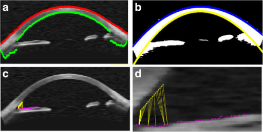 Descripción: Clinical examination revealed 7-mm probing depths, circumferentially around a mandibular implant, bleeding on probing, and the presence of exudate and gingival inflammatory edema