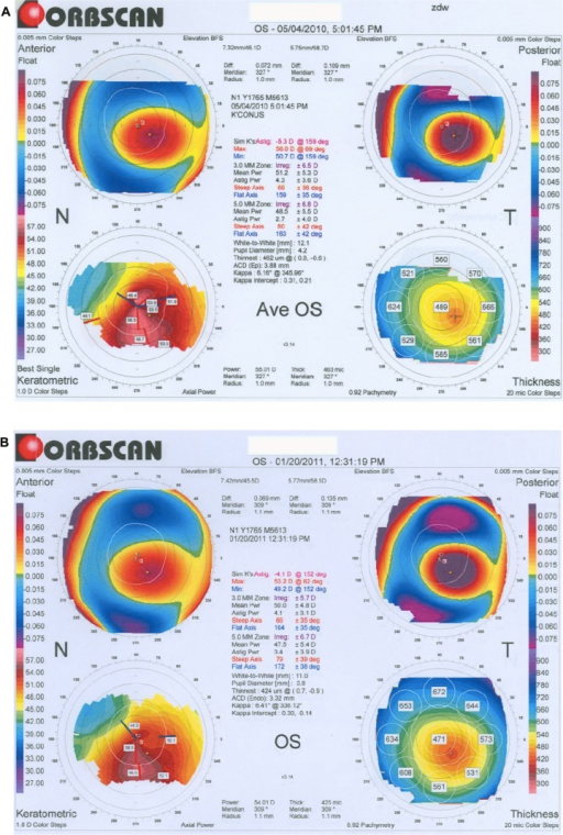 Descripción: Clinical examination revealed 7-mm probing depths, circumferentially around a mandibular implant, bleeding on probing, and the presence of exudate and gingival inflammatory edema