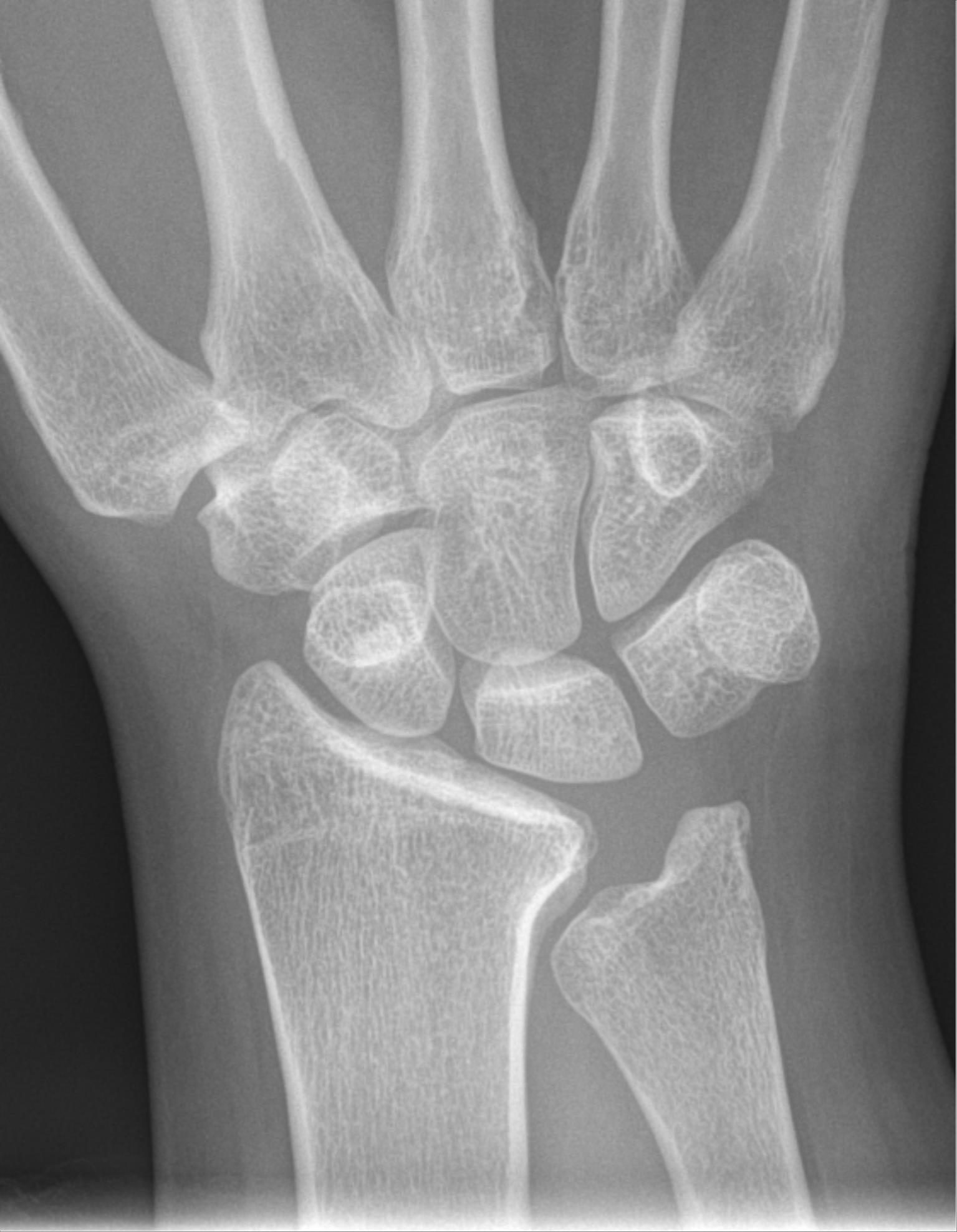 Descripción: Clinical examination revealed 7-mm probing depths, circumferentially around a mandibular implant, bleeding on probing, and the presence of exudate and gingival inflammatory edema