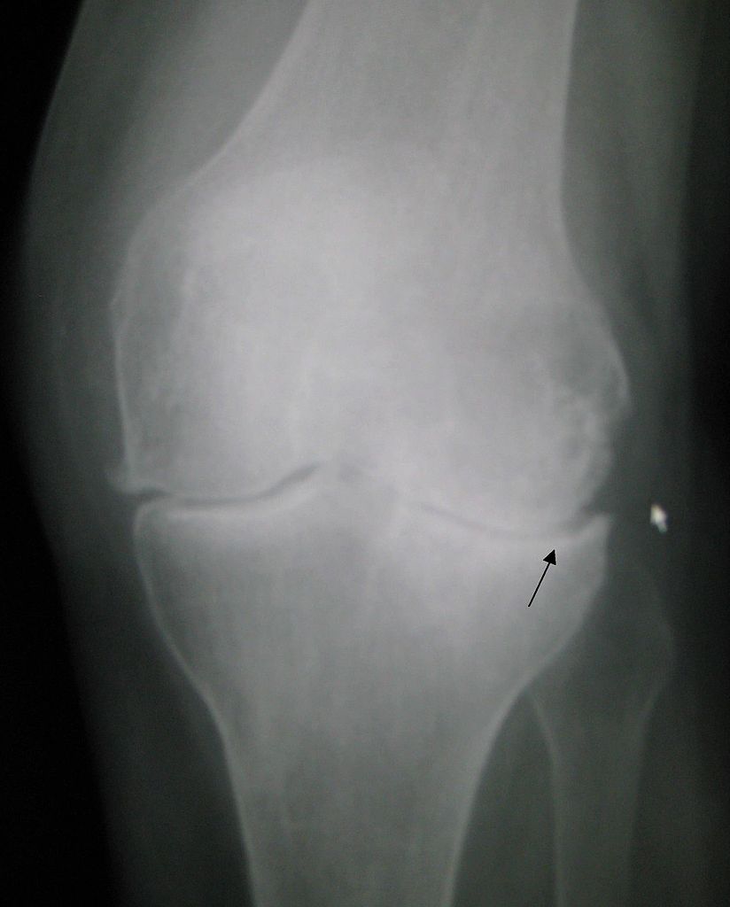 Descripción: Clinical examination revealed 7-mm probing depths, circumferentially around a mandibular implant, bleeding on probing, and the presence of exudate and gingival inflammatory edema