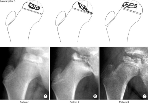 Descripción: Clinical examination revealed 7-mm probing depths, circumferentially around a mandibular implant, bleeding on probing, and the presence of exudate and gingival inflammatory edema