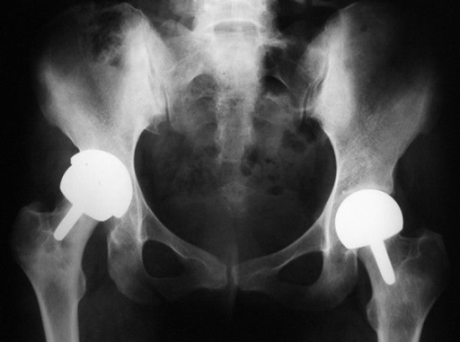 Descripción: Clinical examination revealed 7-mm probing depths, circumferentially around a mandibular implant, bleeding on probing, and the presence of exudate and gingival inflammatory edema