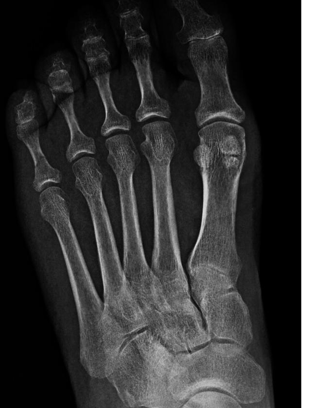 Descripción: Clinical examination revealed 7-mm probing depths, circumferentially around a mandibular implant, bleeding on probing, and the presence of exudate and gingival inflammatory edema