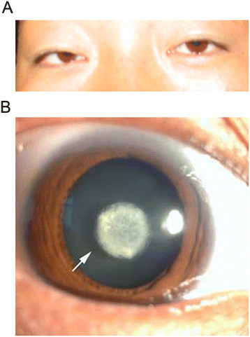 Descripción: Clinical examination revealed 7-mm probing depths, circumferentially around a mandibular implant, bleeding on probing, and the presence of exudate and gingival inflammatory edema