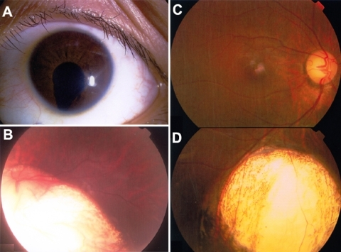 Descripción: Clinical examination revealed 7-mm probing depths, circumferentially around a mandibular implant, bleeding on probing, and the presence of exudate and gingival inflammatory edema