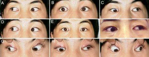 Descripción: Clinical examination revealed 7-mm probing depths, circumferentially around a mandibular implant, bleeding on probing, and the presence of exudate and gingival inflammatory edema