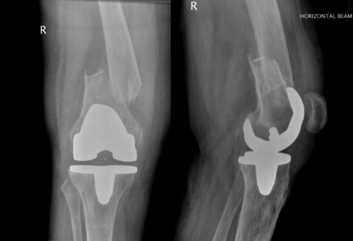 Descripción: Clinical examination revealed 7-mm probing depths, circumferentially around a mandibular implant, bleeding on probing, and the presence of exudate and gingival inflammatory edema