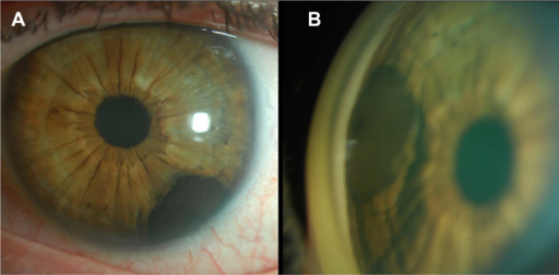 Descripción: Clinical examination revealed 7-mm probing depths, circumferentially around a mandibular implant, bleeding on probing, and the presence of exudate and gingival inflammatory edema