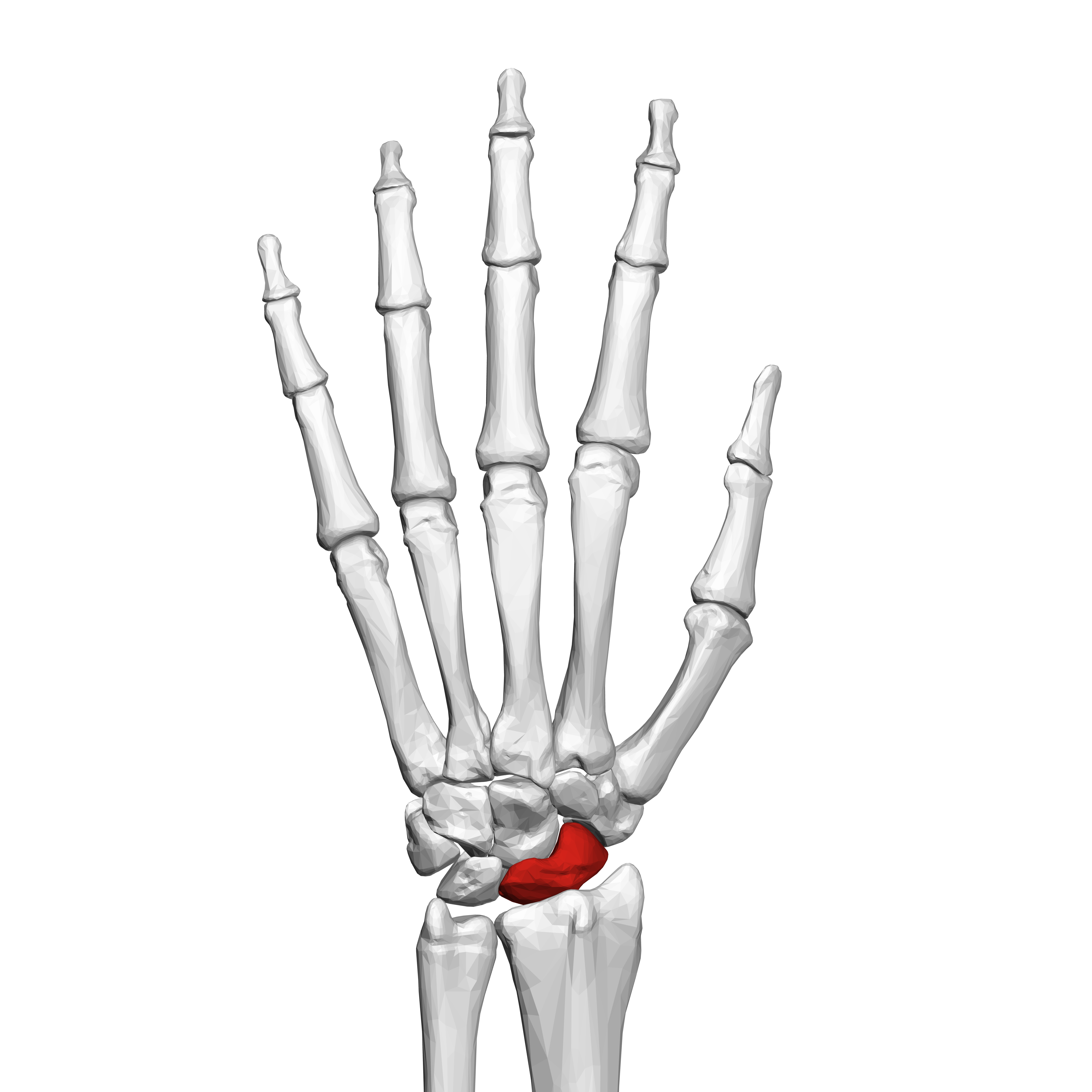 Descripción: Clinical examination revealed 7-mm probing depths, circumferentially around a mandibular implant, bleeding on probing, and the presence of exudate and gingival inflammatory edema