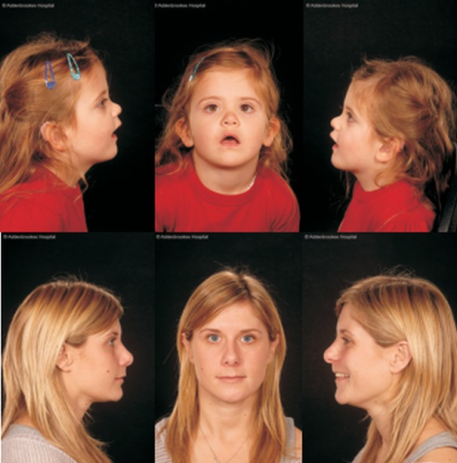 Descripción: Clinical examination revealed 7-mm probing depths, circumferentially around a mandibular implant, bleeding on probing, and the presence of exudate and gingival inflammatory edema