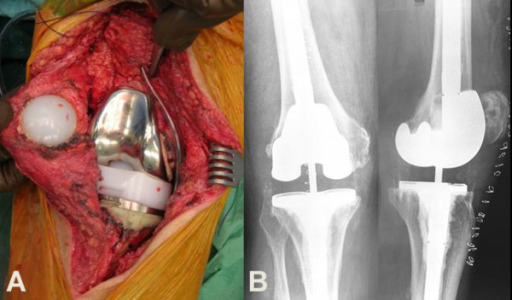 Descripción: Clinical examination revealed 7-mm probing depths, circumferentially around a mandibular implant, bleeding on probing, and the presence of exudate and gingival inflammatory edema